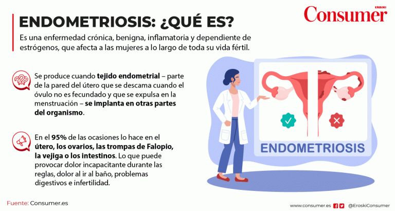 Qué Es La Endometriosis Consumer 5909
