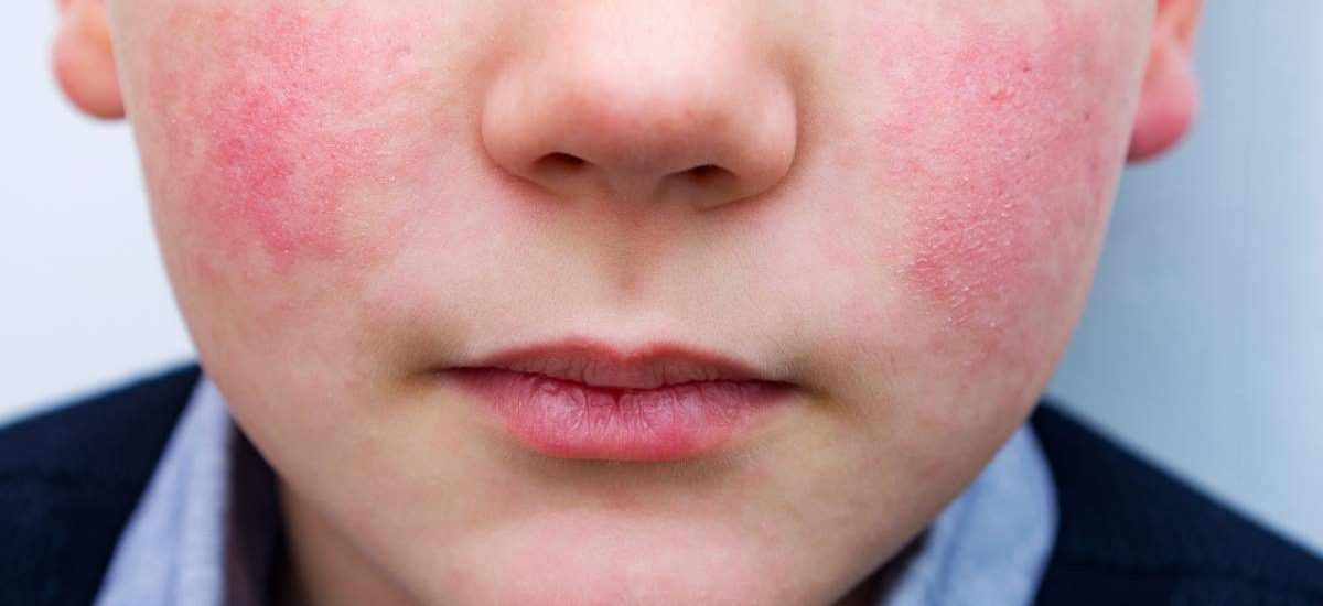 slapped-cheek-syndrome-this-childhood-condition-causes-red-cheeks-goodto