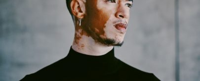 tratamiento del vitiligo